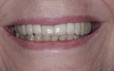 Close-up of a smiling person's mouth showing teeth with braces on the front two teeth.