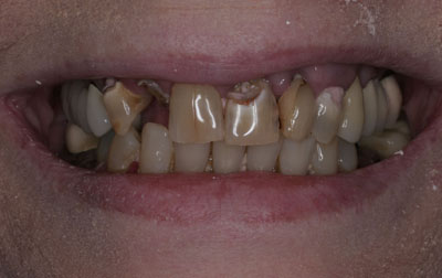 Close-up image of a person's mouth slightly open, showing uneven and discolored teeth with visible dental issues.