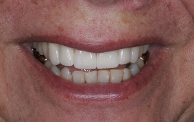 Close-up of a smiling mouth showing teeth, with focus on healthy white teeth and slightly pink lips.
