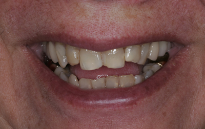 Close-up of a smiling mouth showing teeth with slight discoloration and a gold dental crown on a lower tooth.