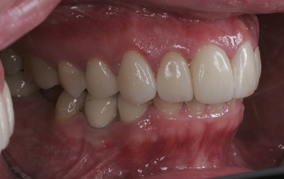 Close-up view of a person's open mouth showing teeth and gums, focusing on dental health with visible fillings on lower teeth.