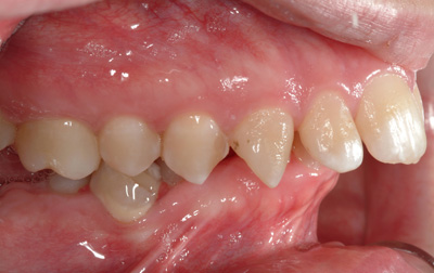 Close-up view of a human mouth showing irregularly aligned teeth and inflamed gums.