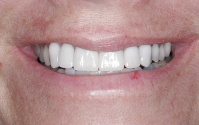 Close-up of a smiling person's mouth showing white teeth, with a small red spot on the lower lip.