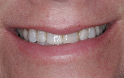 Close-up of a smiling mouth showing teeth, some teeth have noticeable stains.